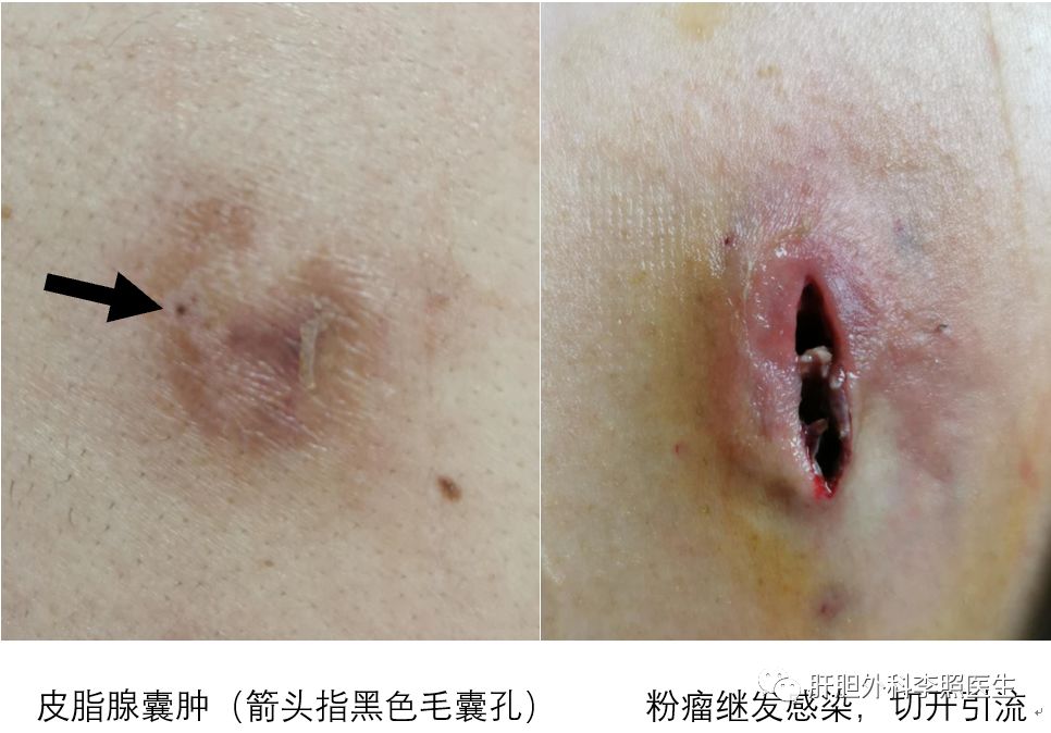 认识几种常见的体表肿物 医学界 助力医生临床决策和职业成长