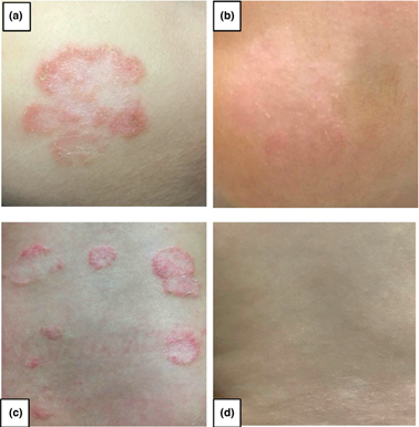 不止马拉色菌特应性皮炎相关真菌还有这几种