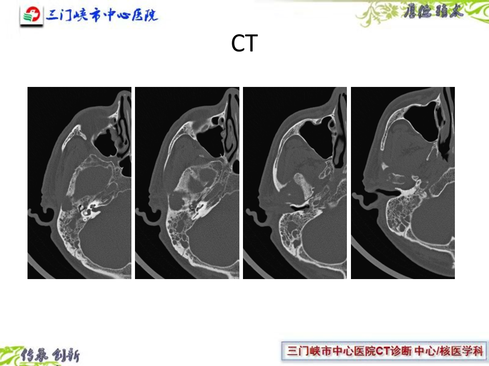 中耳炎ct影像表现图片图片