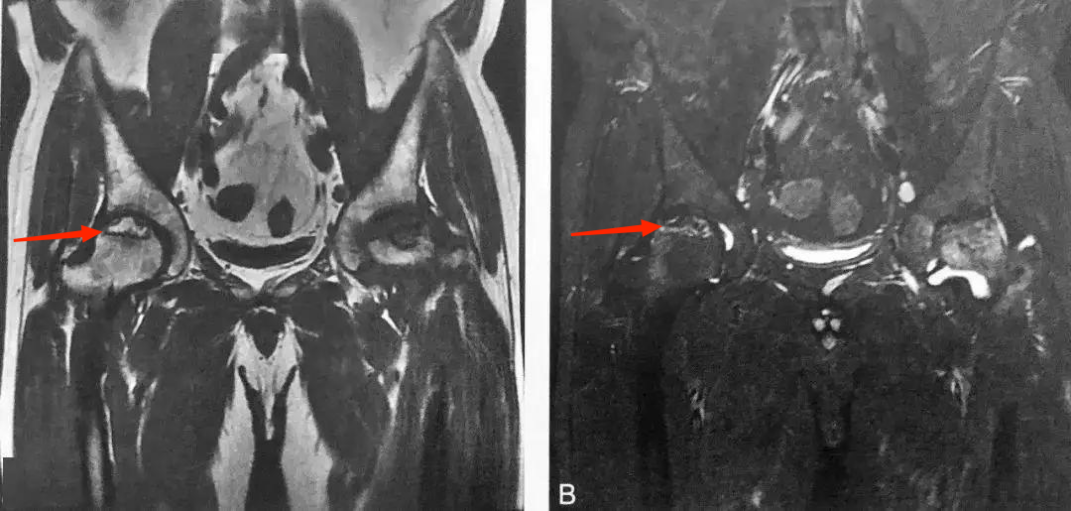 股骨头坏死双线征图片图片