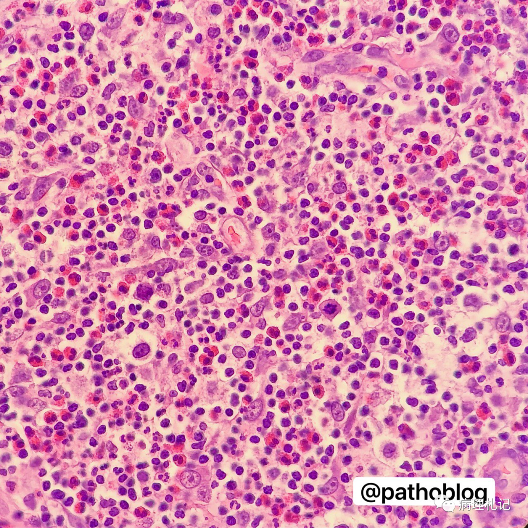 经典型霍奇金淋巴瘤看看有多少嗜酸性粒细胞