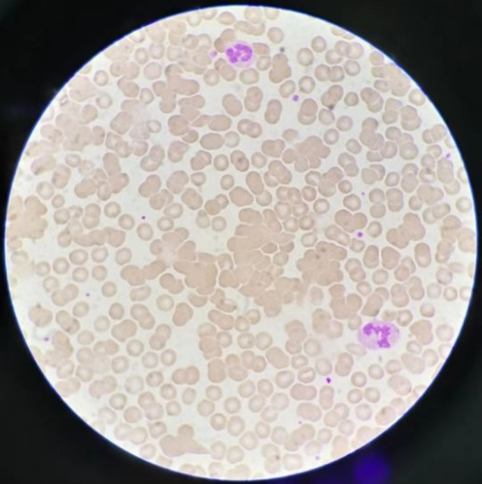 红细胞凝集天天见,你们实验室都是怎样处理的?