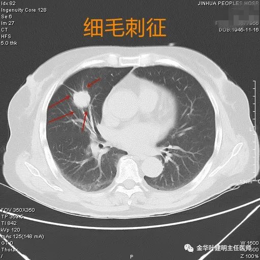 细毛刺征乱石征:这个名称也是我自己想想的,病灶偏实性,就像多个