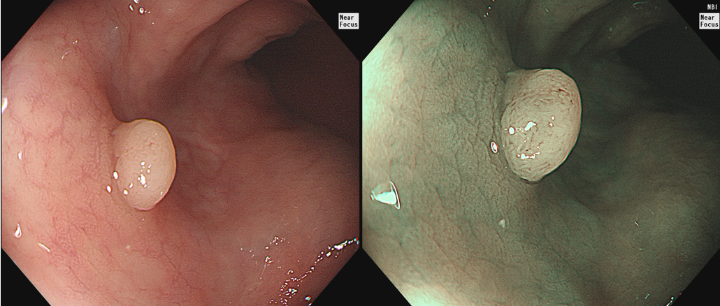 发现结肠息肉如何区分这11张图你一定要掌握