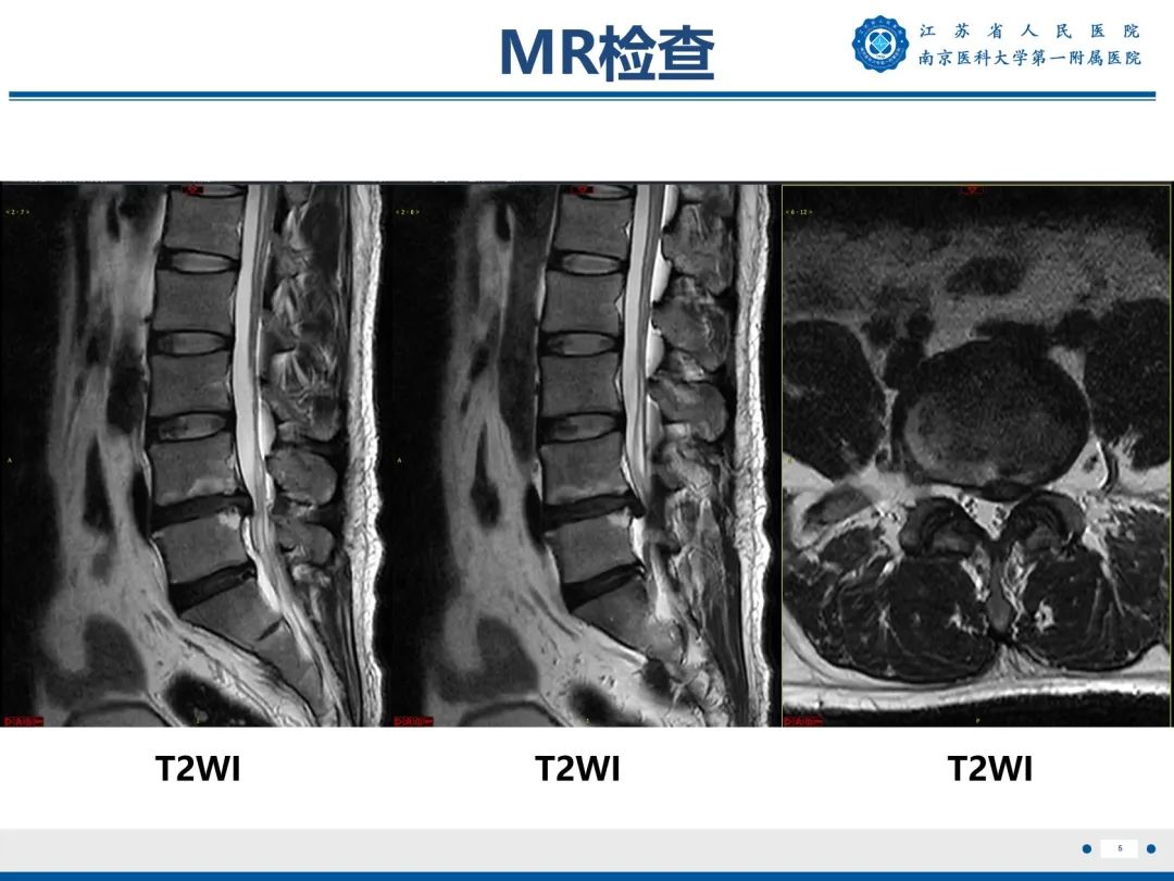 椎体终板炎:modic改变及mri表现