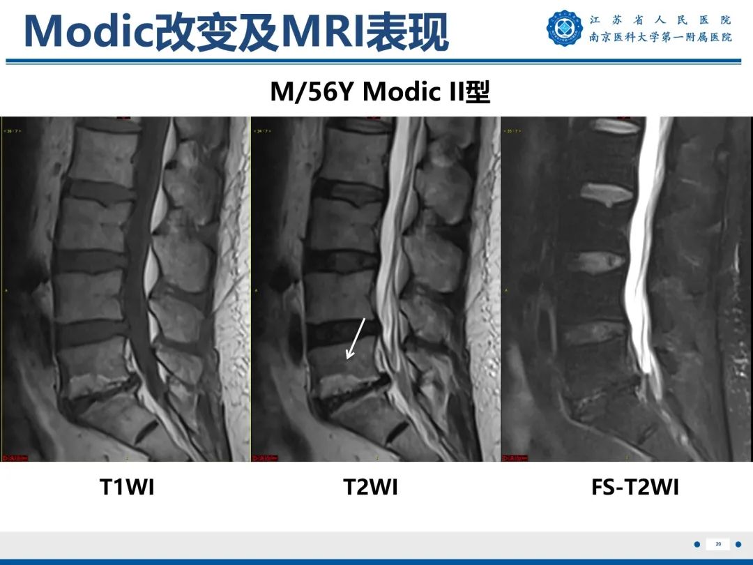 椎体终板炎:modic改变及mri表现