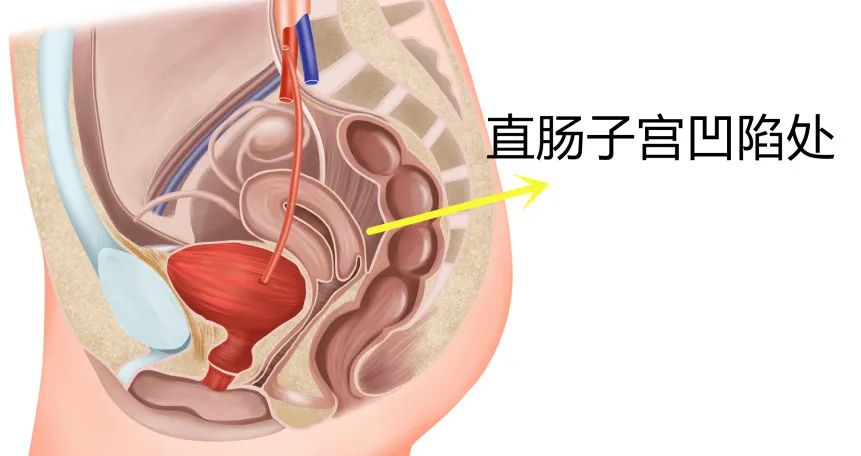 盆腔积液图片结构图图片