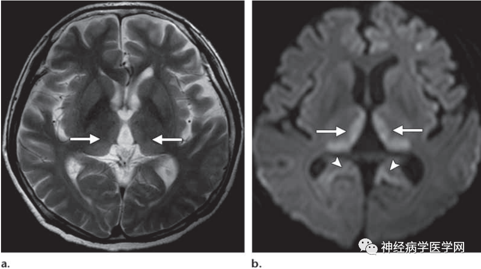 图文详解 | 双侧基底节区及丘脑病变的鉴别诊断