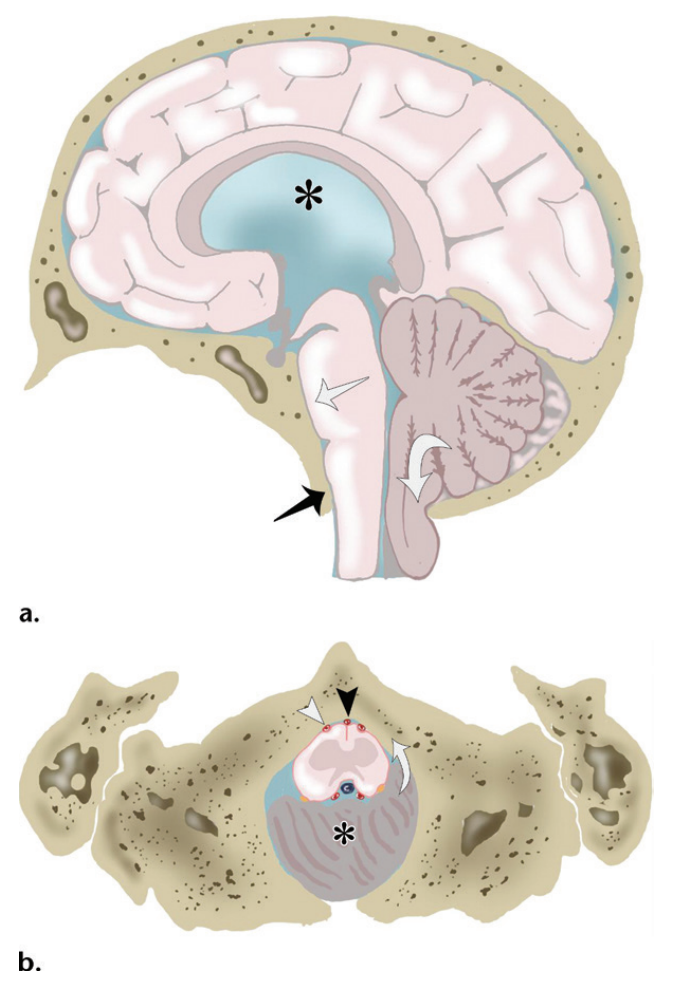 (a图)小脑扁桃体延伸至枕骨大孔的下方(白色弯曲箭头),脑干挤压斜坡