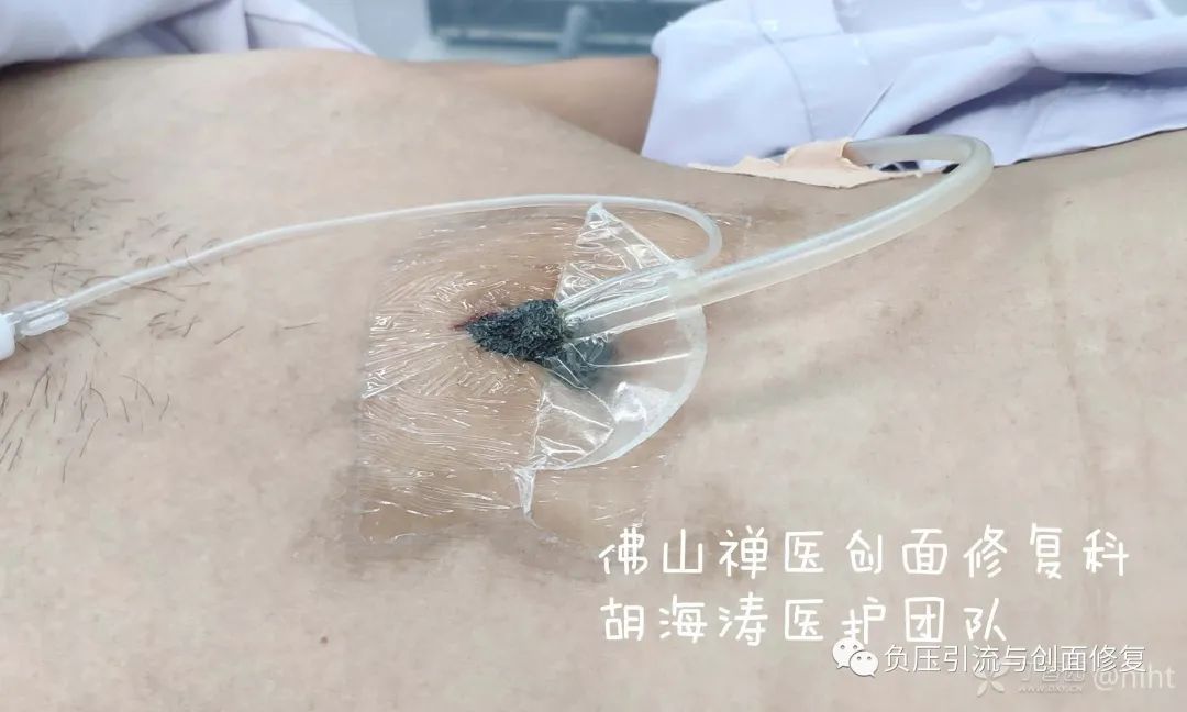 病例:肚脐潮湿,发臭30年,肿痛流脓1月,诊断为脐尿管瘘