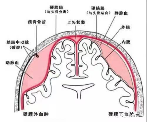 脑膜瘤示意图图片