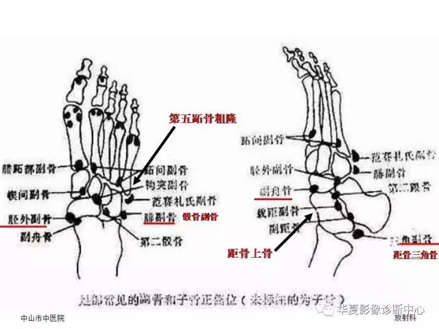 籽骨,副骨及永存骨骺,常见请不要误诊!