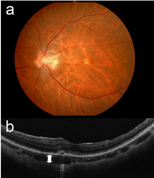 黄斑前膜术后,为何视网膜脉络膜大面积萎缩?有4点关键原因