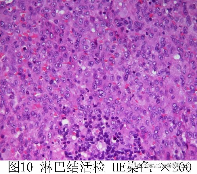 一文读懂朗格汉斯细胞组织细胞增生症的前世今生