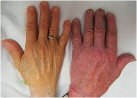 真性红细胞增多症和脑卒中有什么关系?