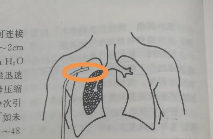 胸腔置管图片