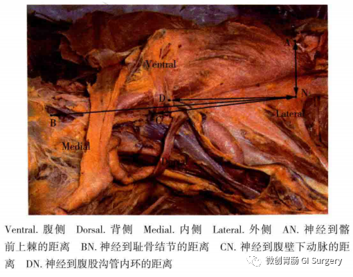 腹腔鏡腹股溝疝修補術解剖之疼痛三角(神經的辨識和保護)_醫學界-助力