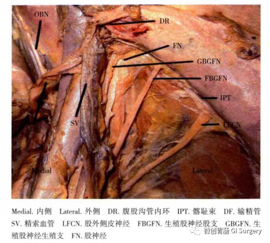 腹腔鏡腹股溝疝修補術解剖之疼痛三角(神經的辨識和保護)_醫學界-助力