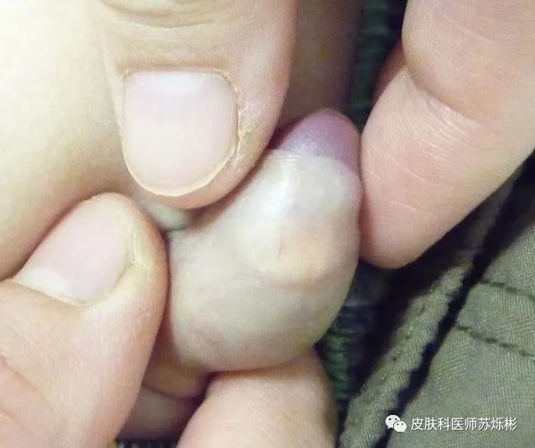 婴幼儿包皮下长了颗黄色结节,这是什么疾病?