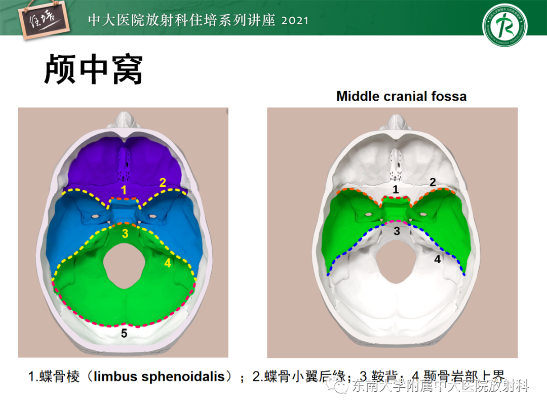 中颅窝底解剖结构及常见骨折征象