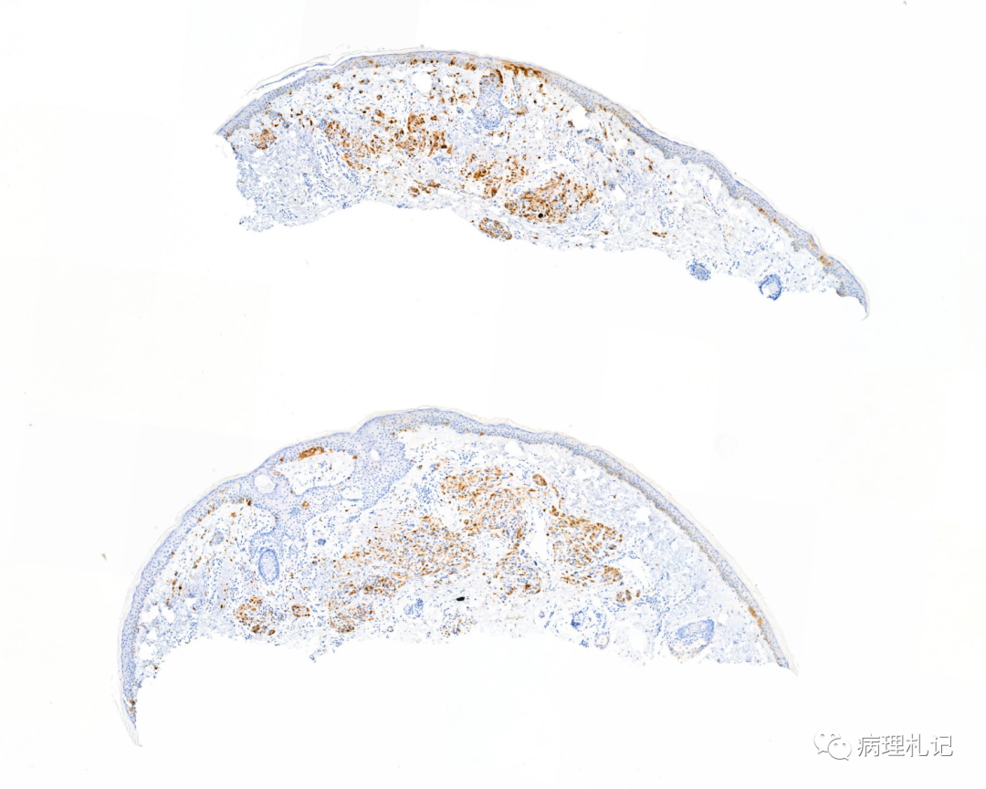 dpn和其不典型类型和黑色素瘤在病理切片下的鉴别_医学界-助力医生
