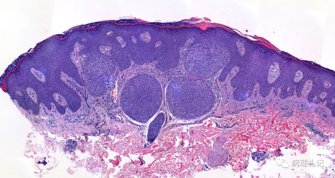 皮脂腺切片图片