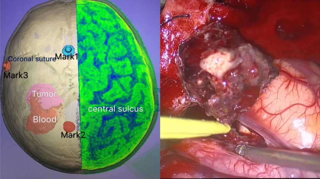 伴有急性出血的血管中心型胶质瘤1例及随访报告
