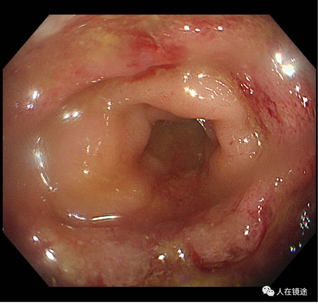 回肠末端淋巴瘤图片