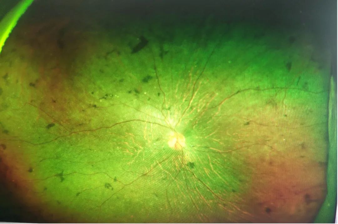 胡大夫的眼科门诊——一种可怕的「夜盲症」