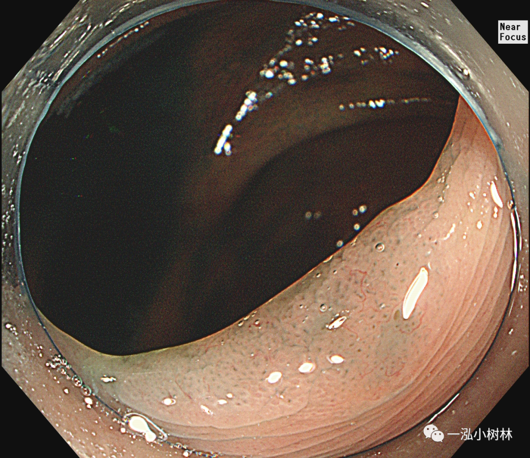 图 靛胭脂染色:升结肠侧向发育型息肉(ssl),openii型腺管,表面蛇形