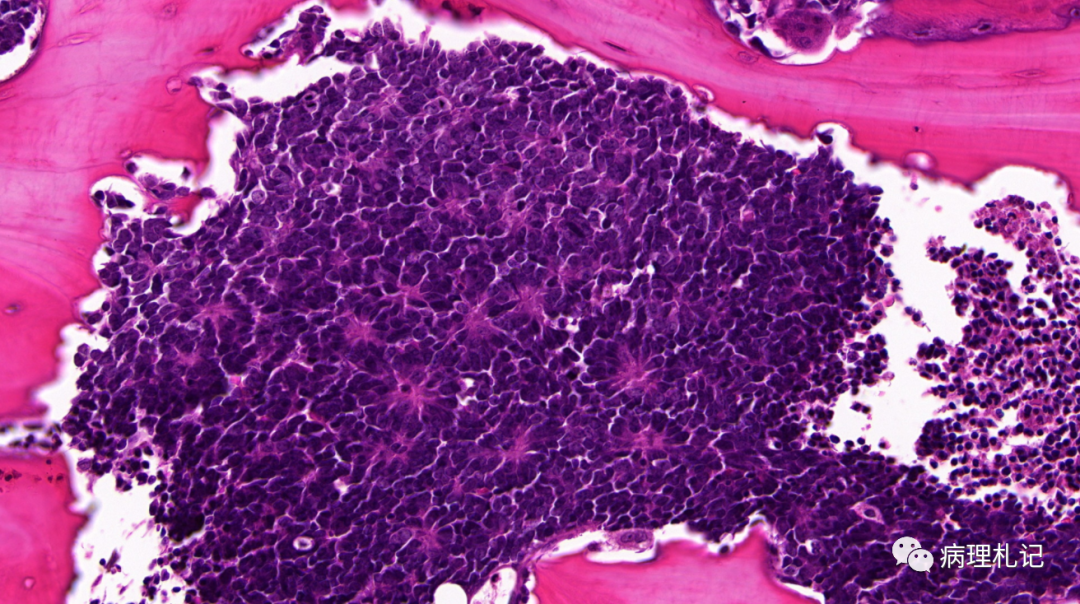 弥漫性神经纤维瘤中惊叹wagner-meissner小体