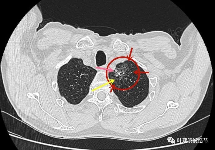 一个病人多个病灶,形态各异,集齐不同亚型肺腺癌的特点……