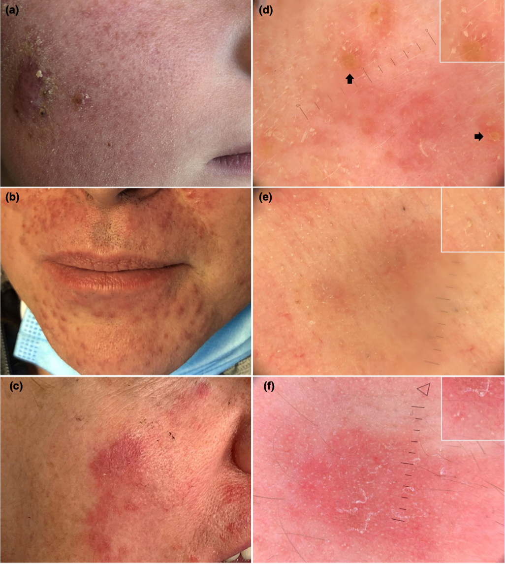 皮肤镜检查中可能误诊为蠕形螨病的陷阱_医学界-助力医生临床决策和