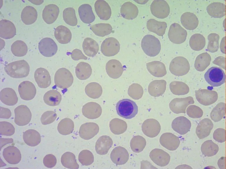血小板),嗜酸性粒细胞比例增高,可见2%原始细胞(图2,3红细胞大小不