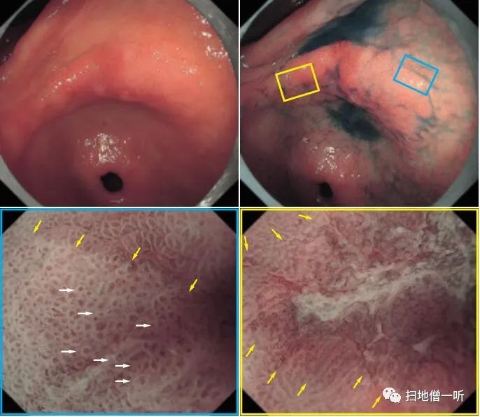 胃十二指肠内镜放大观察 | 放大内镜诊断体系_医学界-助力医生临床