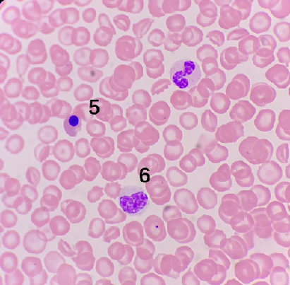 漿內較多粗顆粒,需與顆粒增多的中性中幼粒鑑別;細胞3和4胞漿豐富,灰