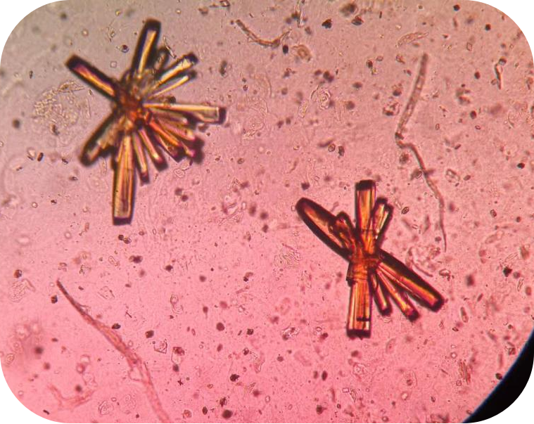 显微镜检发现"菊花状"的结晶如图2-3.