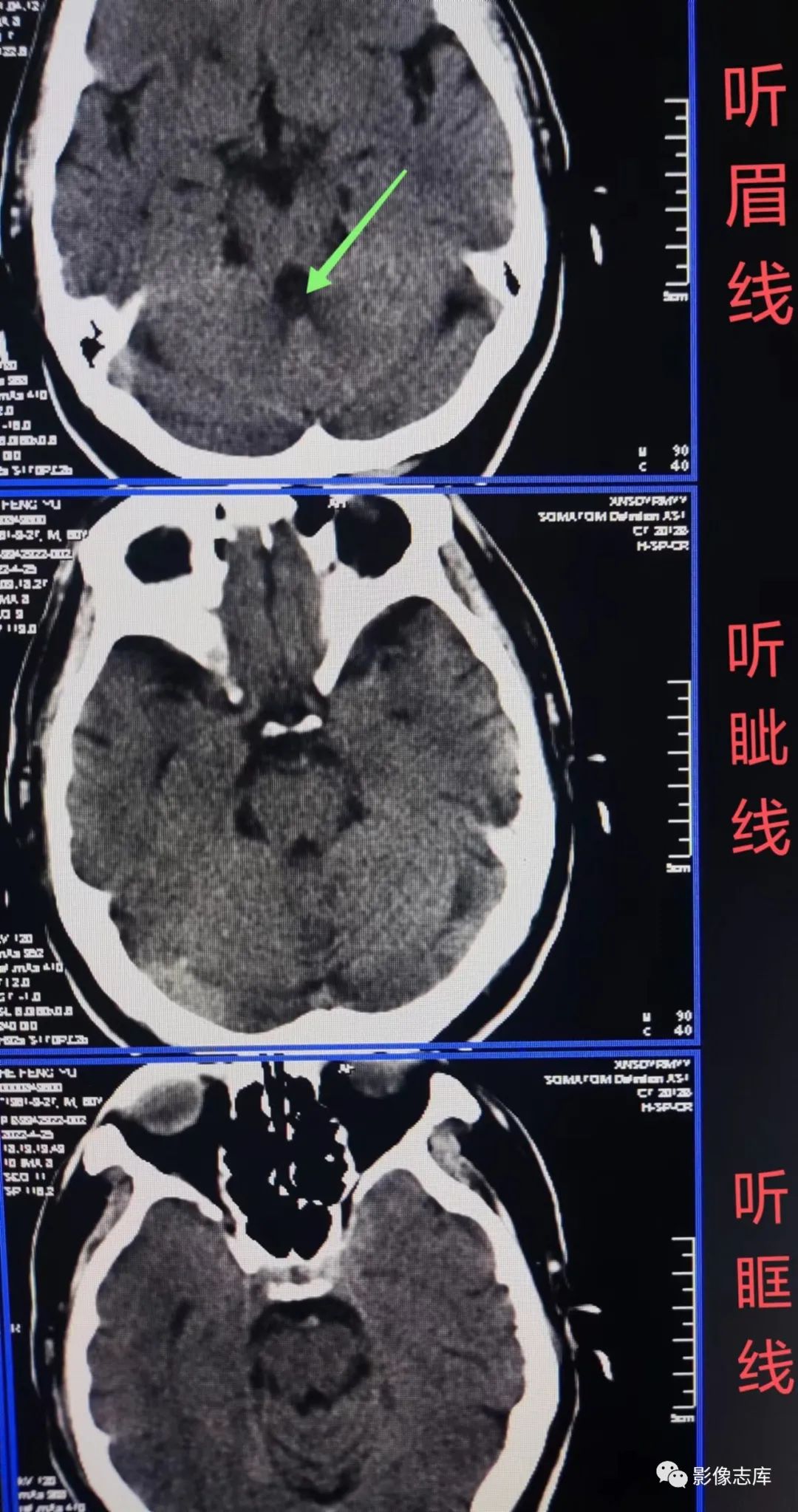 头颅ct扫描时如何打角度
