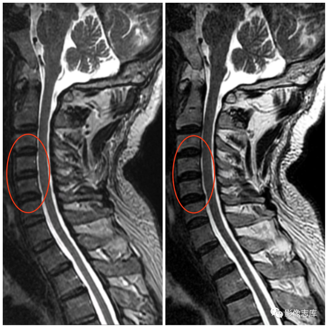 带宽对mr图像有何影响
