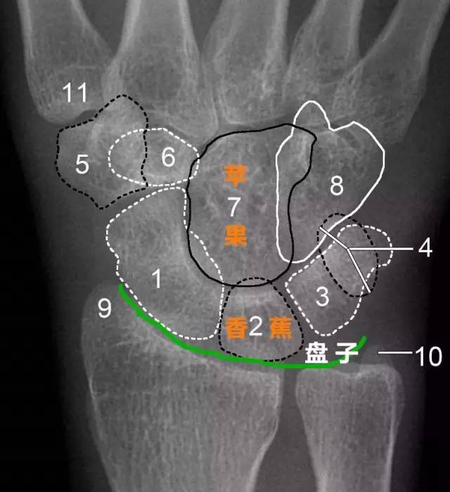 手解剖结构图x线图片