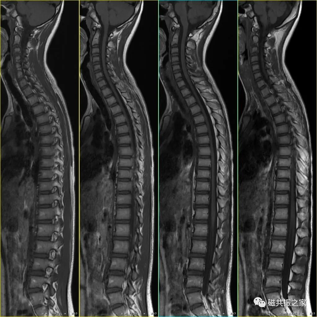 脊椎手術 鄞宗誠醫師 (Tsung-Cheng Yin , M.D.): 一位年輕女性的脊椎骨折脫臼合併脊髓損傷案例