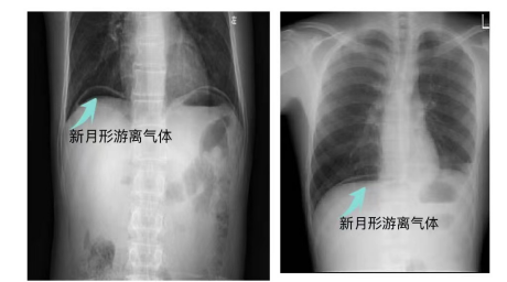 入院后行腹部平片示膈下有新月形游离气体,提示消化道穿孔?