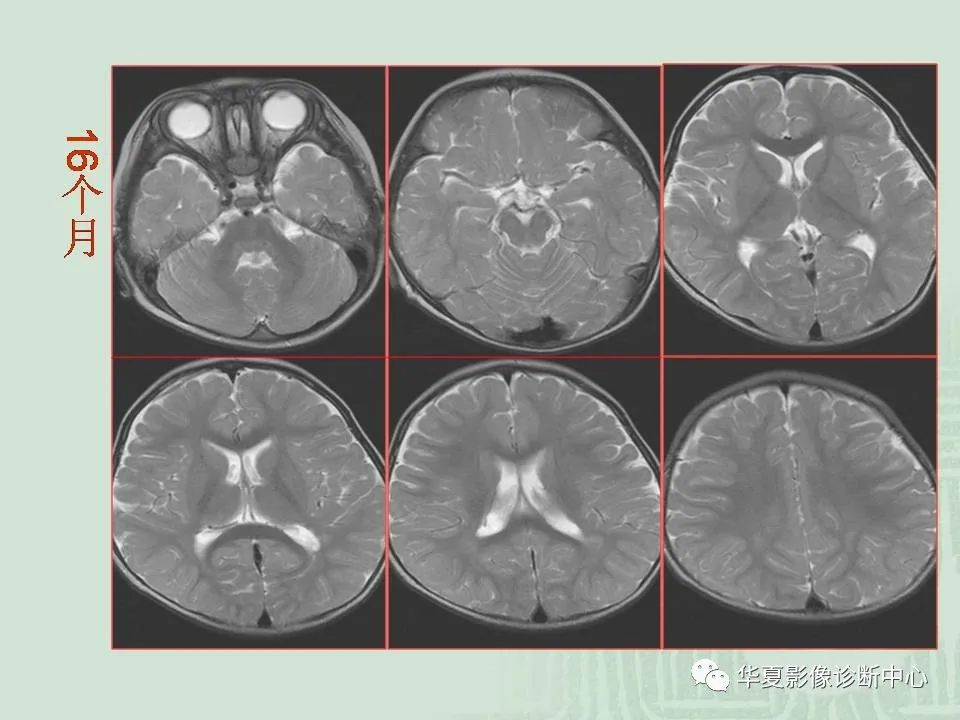 新生儿脑部磁共振正常表现