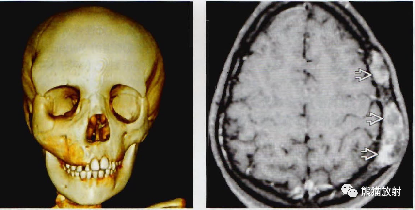 颅骨纤维结构不良,paget病:影像诊断相关要点_医学界