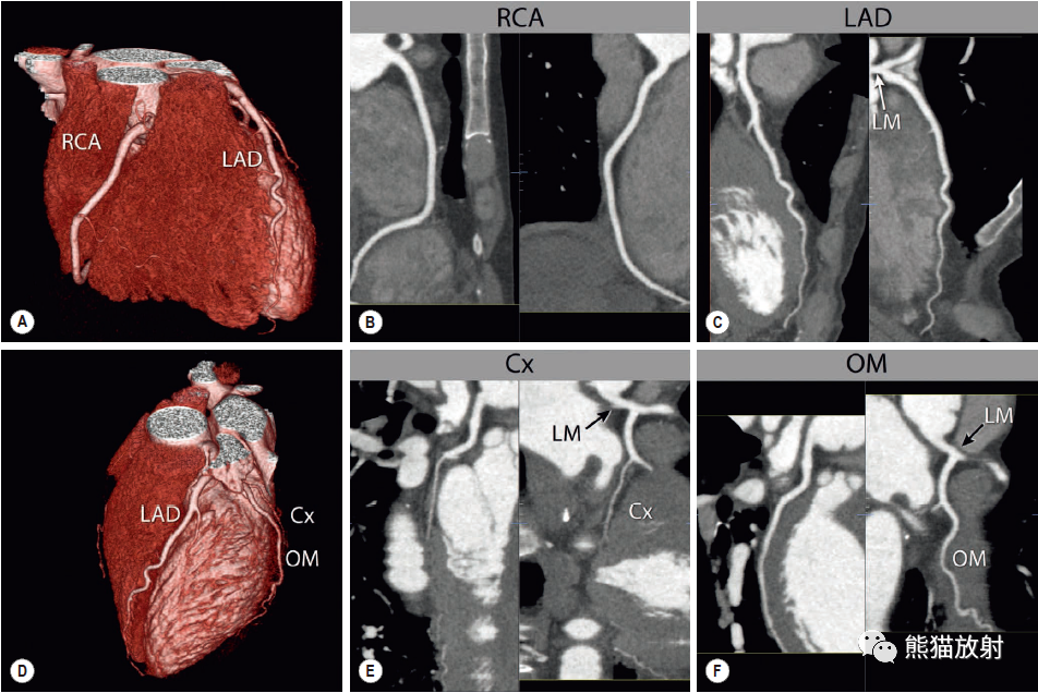 右冠状动脉(b,rca),左前降支(c,lad),回旋支(e,cx)和钝缘支(f,om)