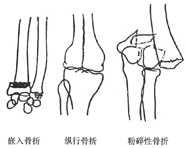 撕脱性骨折示意图图片