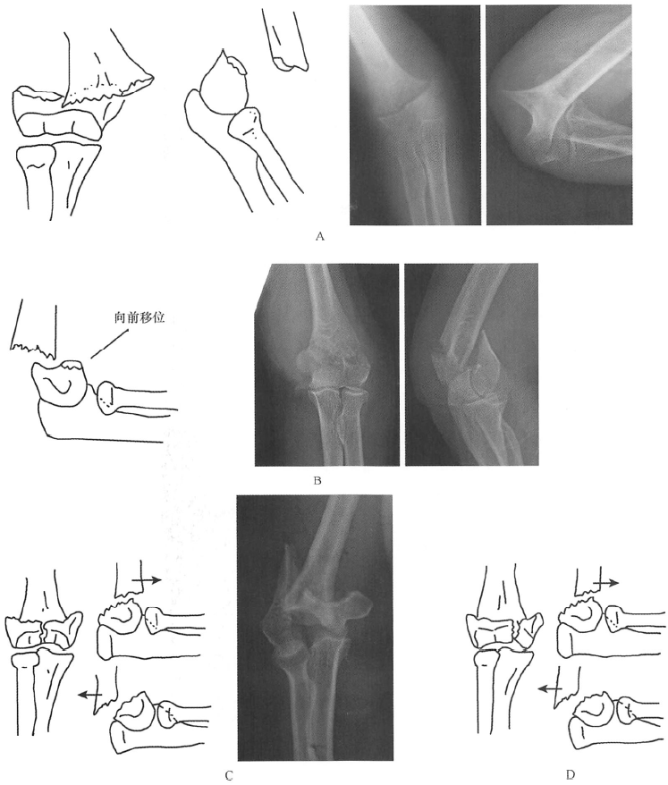 四肢骨折的分型丨上肢骨折及脱位