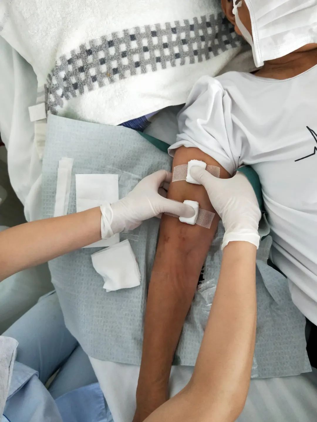 内瘘穿刺血肿后该不该立刻拔针