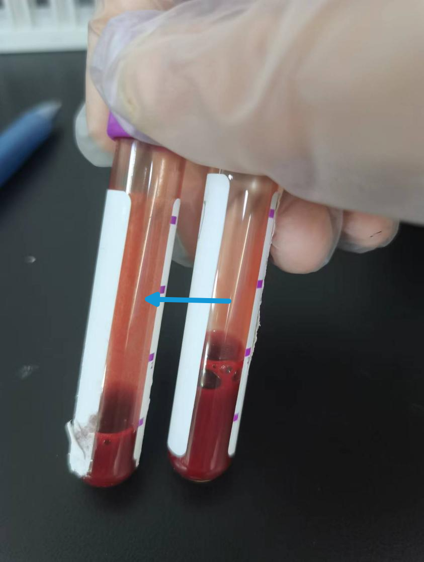 天冷了,抱团取暖的红细胞们——冷凝集_医学界-助力医生临床决策和