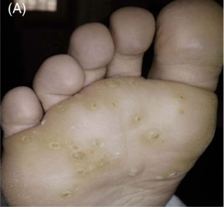 跖疣是由人乳头瘤样病毒(hpv)感染引起的一种皮肤疾病[2],表现为足部